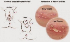 Common sites of Herpes - Men-Women
