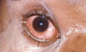 Eye gonorrhea picture