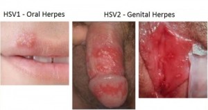 Genital-Herpes-HV1-HV2