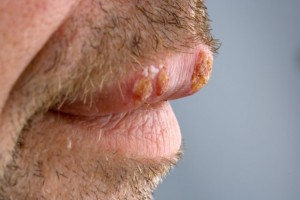 herpes-cold sores