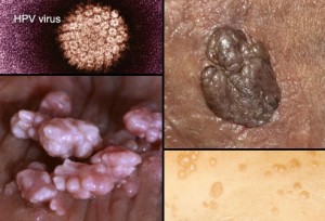 stds-s1-photo-of-genital-warts