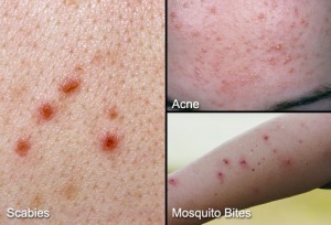webmd_rm_photo_of_various_skin_irritations