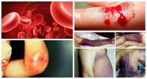 Haemophilia-The-Bleeding-Condition-media