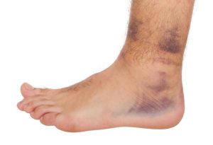 anklebruising